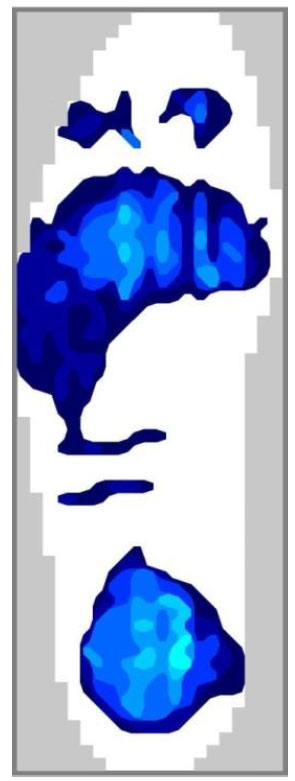 foot pressure distribution