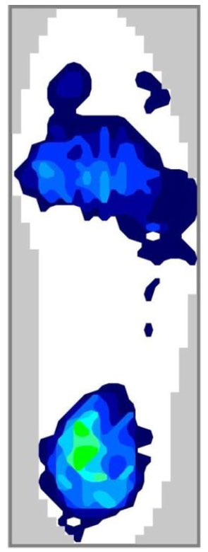 Fuß-Druckverteilung